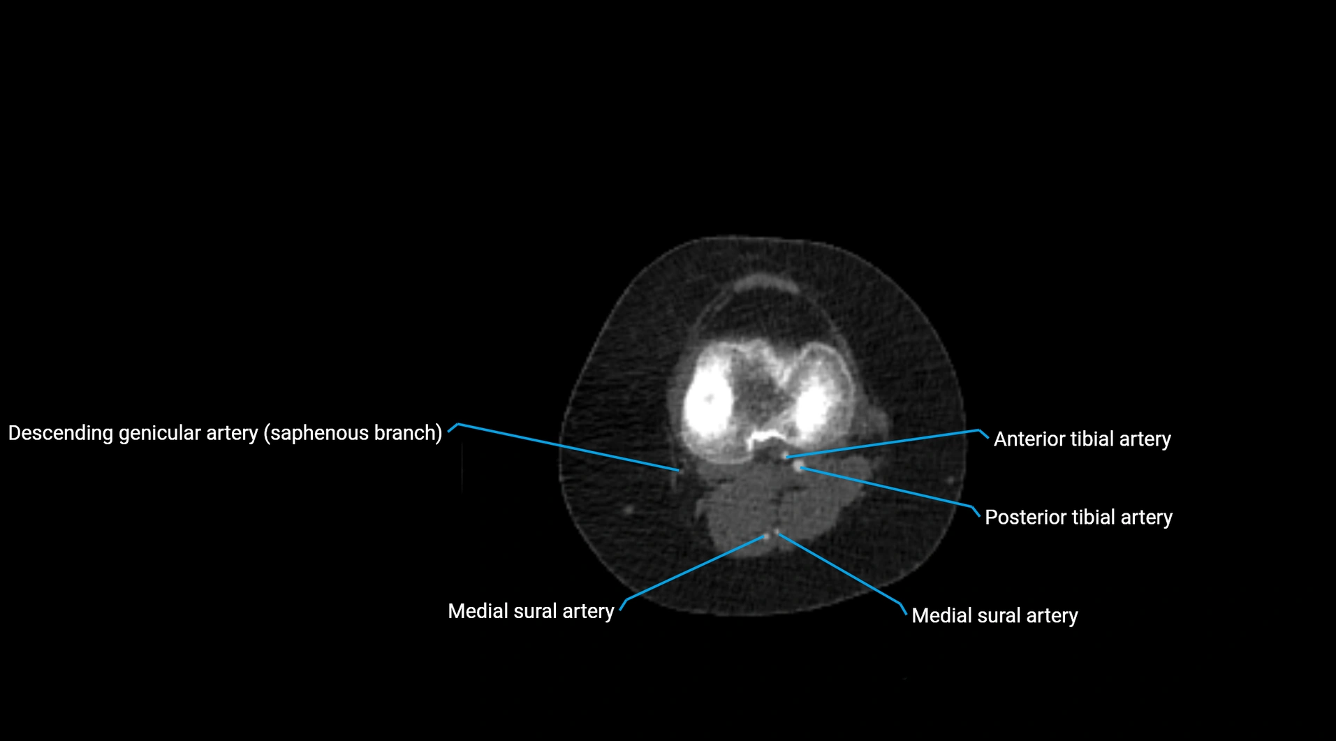 CTA lower limb cross sectional anatomy labelled image _178.webp